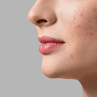 Lattoferrina e salute della pelle: un nuovo alleato contro l'acne?